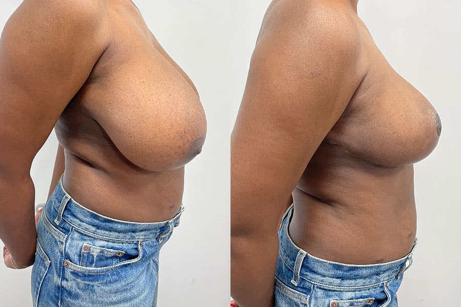 Before and after photograph of a patient of Dr. Karan Mehta