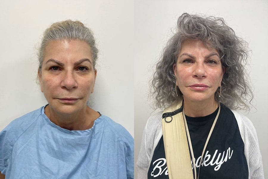 Before and after photograph of a patient of Dr. Karan Mehta