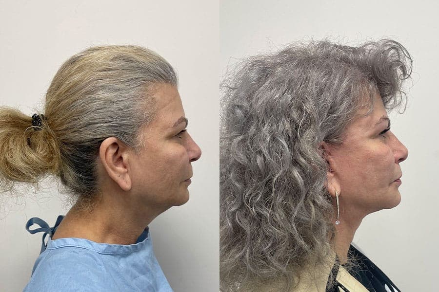 Before and after photograph of a patient of Dr. Karan Mehta
