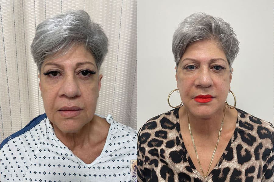 Before and after photograph of a patient of Dr. Karan Mehta
