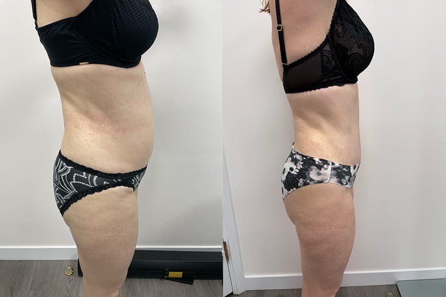 Before and after photograph of a patient of Dr. Karan Mehta