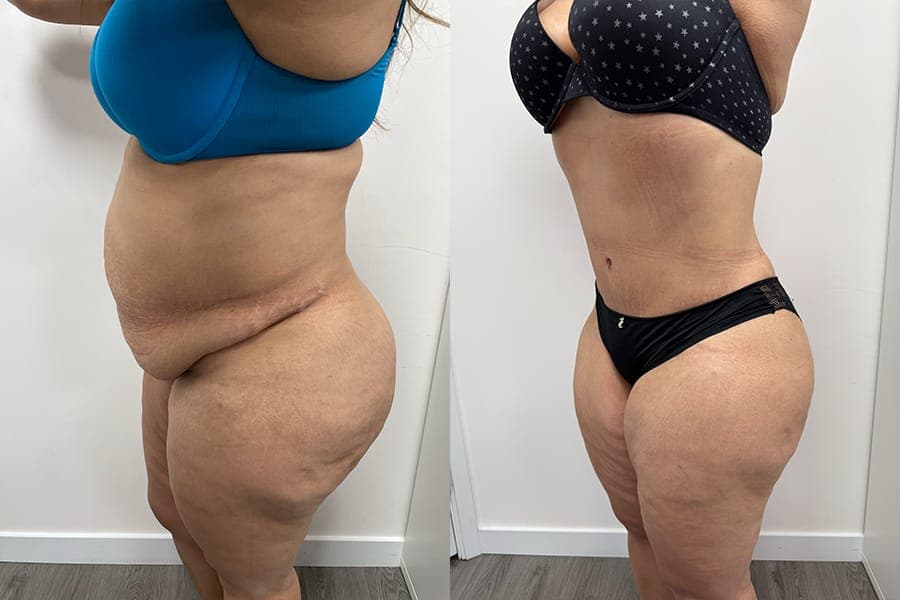 Before and after photograph of a patient of Dr. Karan Mehta