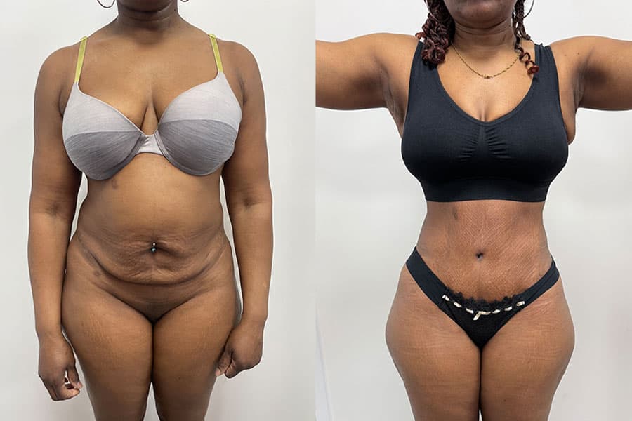 Before and after photograph of a patient of Dr. Karan Mehta