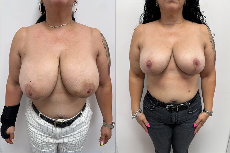 Before and after photograph of a patient of Dr. Karan Mehta