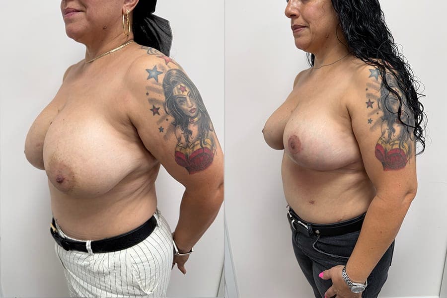 Before and after photograph of a patient of Dr. Karan Mehta