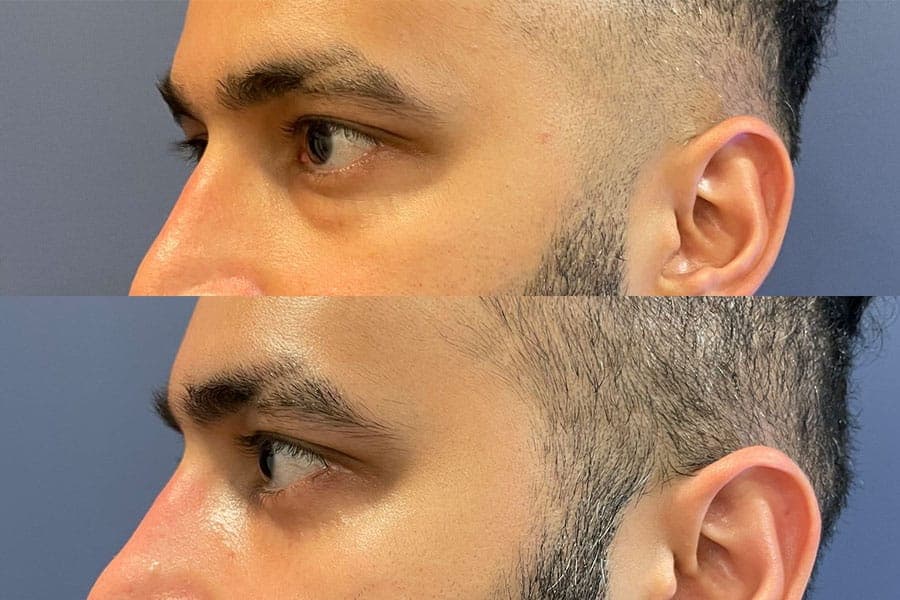 Before and after photograph of a patient of Dr. Karan Mehta