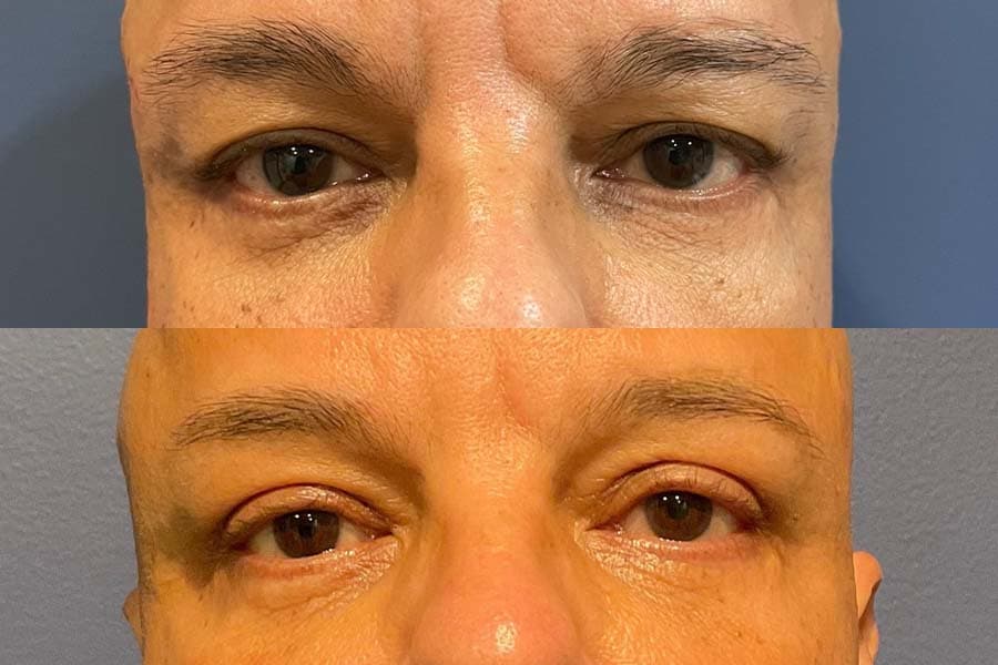 Before and after photograph of a patient of Dr. Karan Mehta
