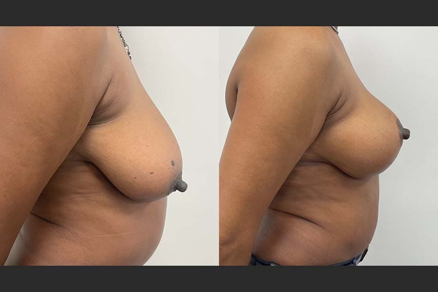 Before and after photograph of a patient of Dr. Karan Mehta