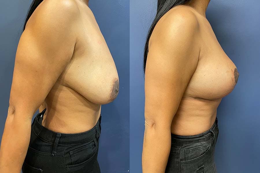 Before and after photograph of a patient of Dr. Karan Mehta