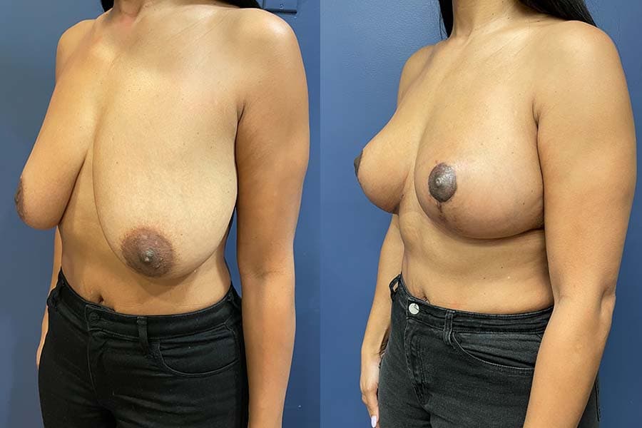 Before and after photograph of a patient of Dr. Karan Mehta
