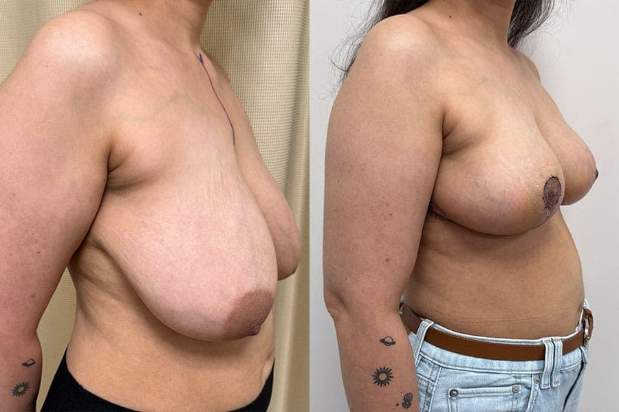 Before and after photograph of a patient of Dr. Karan Mehta