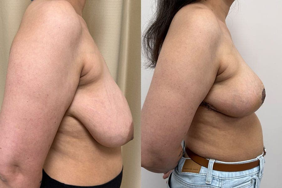 Before and after photograph of a patient of Dr. Karan Mehta