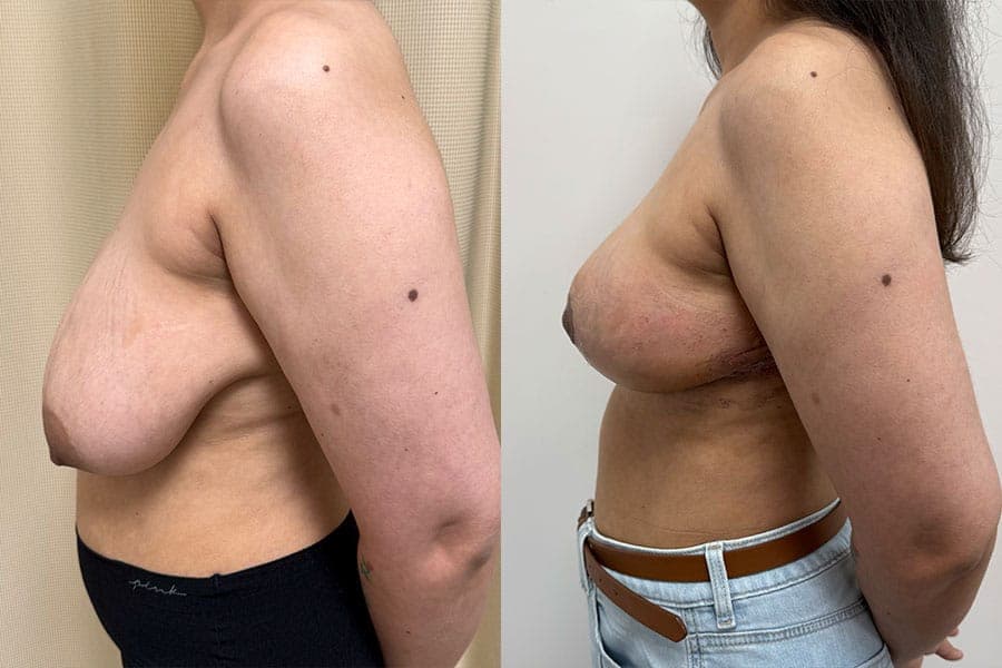 Before and after photograph of a patient of Dr. Karan Mehta