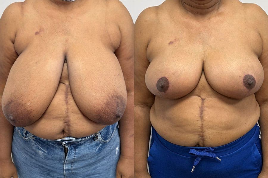 Before and after photograph of a patient of Dr. Karan Mehta