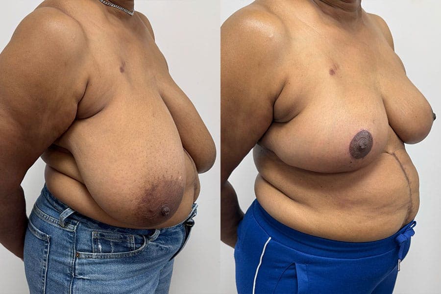 Before and after photograph of a patient of Dr. Karan Mehta