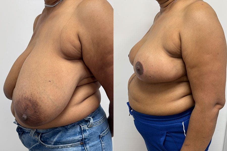 Before and after photograph of a patient of Dr. Karan Mehta