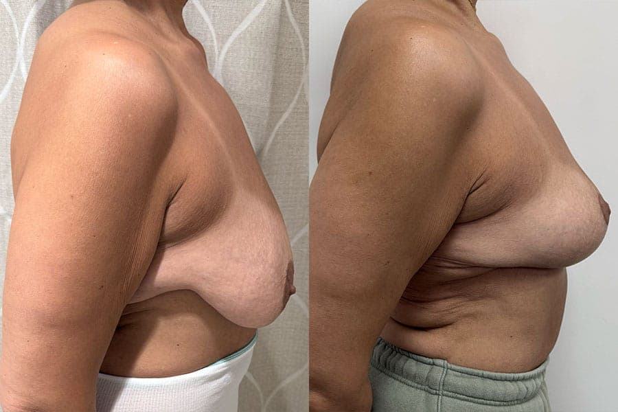 Before and after photograph of a patient of Dr. Karan Mehta