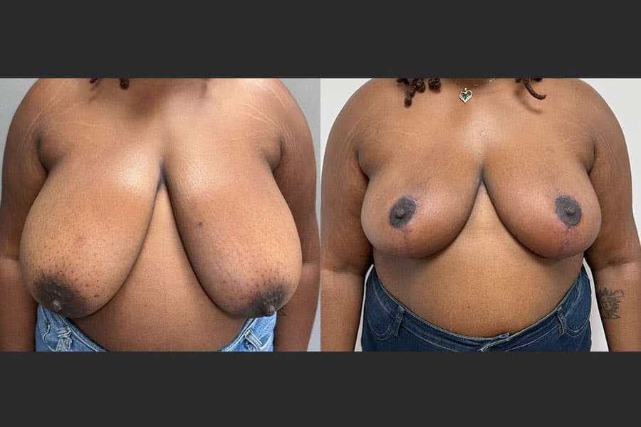Before and after photograph of a patient of Dr. Karan Mehta