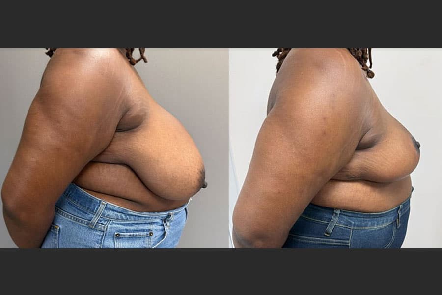 Before and after photograph of a patient of Dr. Karan Mehta