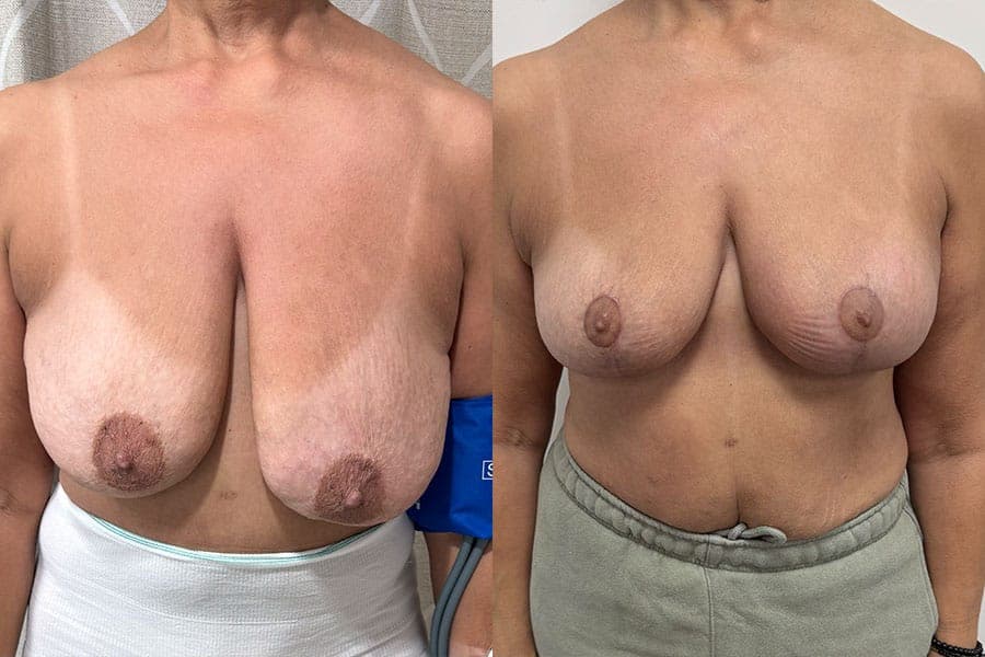Before and after photograph of a patient of Dr. Karan Mehta