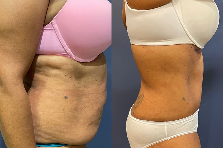 Before and after photograph of a patient of Dr. Karan Mehta
