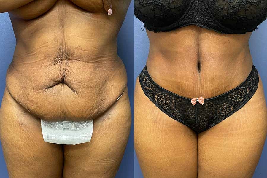 Before and after photograph of a patient of Dr. Karan Mehta