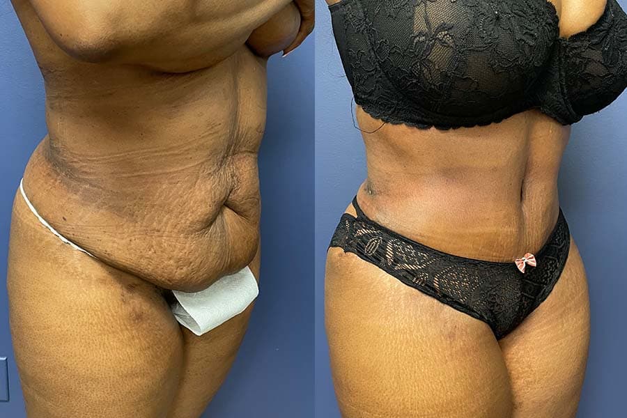 Before and after photograph of a patient of Dr. Karan Mehta