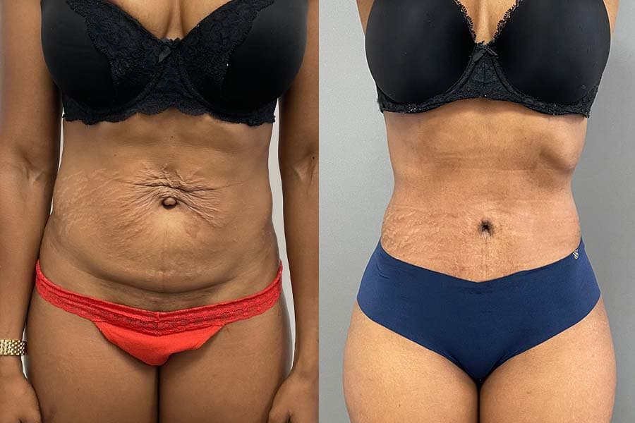 Before and after photograph of a patient of Dr. Karan Mehta