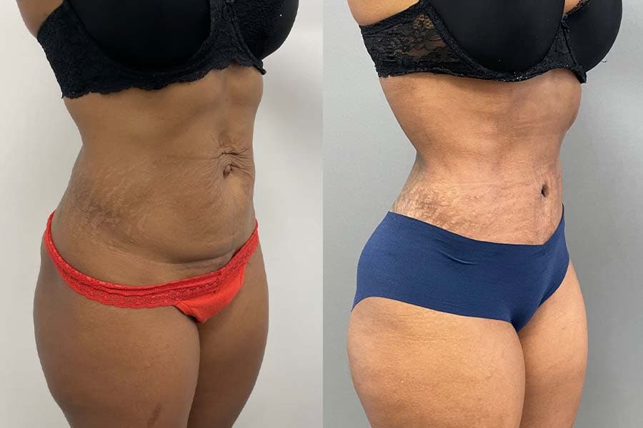 Before and after photograph of a patient of Dr. Karan Mehta