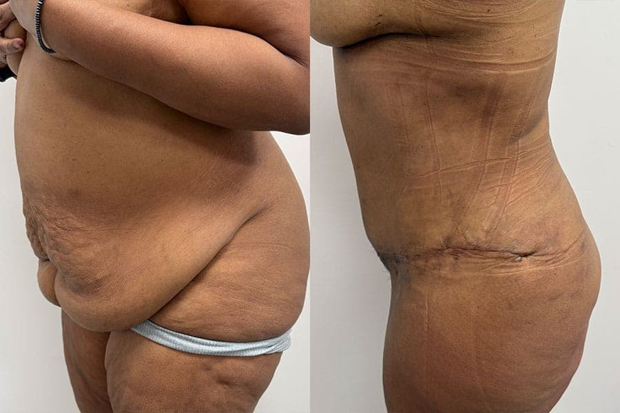 Before and after photograph of a patient of Dr. Karan Mehta